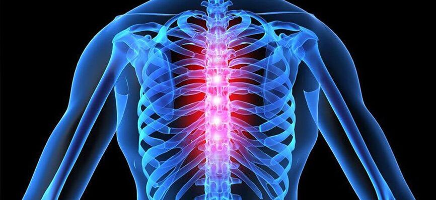 Akutna bolečina je značilna za poslabšanje osteohondroze torakalne hrbtenice. 