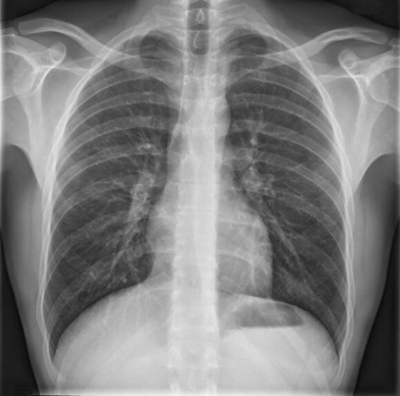 Osteohondroza torakalne hrbtenice se diagnosticira z radiografijo