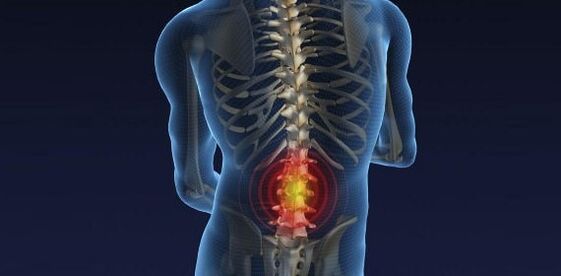 Bolečine v hrbtu z osteohondrozo ledvenega