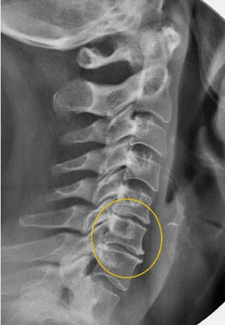 Osteohondroza vratne hrbtenice na rentgeni