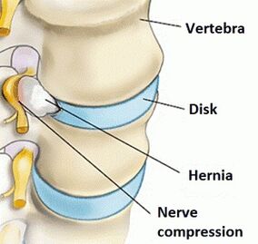 Osteohondroza regije materničnega vratu