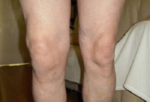 manifestacije artroze kolenskega sklepa (1)