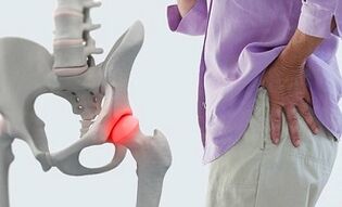vzroki za artrozo kolčnega sklepa