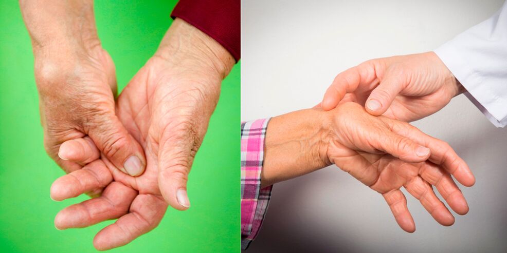 otekanje in bolečine so prvi znaki artritisa rok