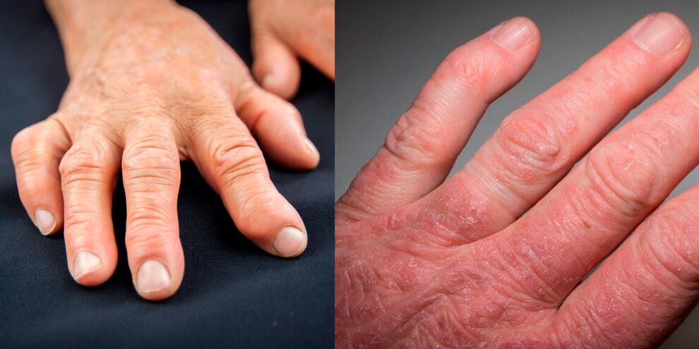 revmatoidni in psoriatični artritis rok