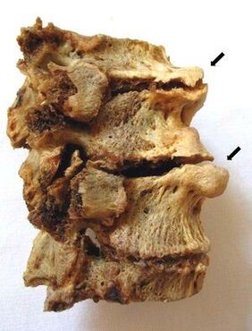 Vretenčni odsek, ki ga prizadene osteohondroza