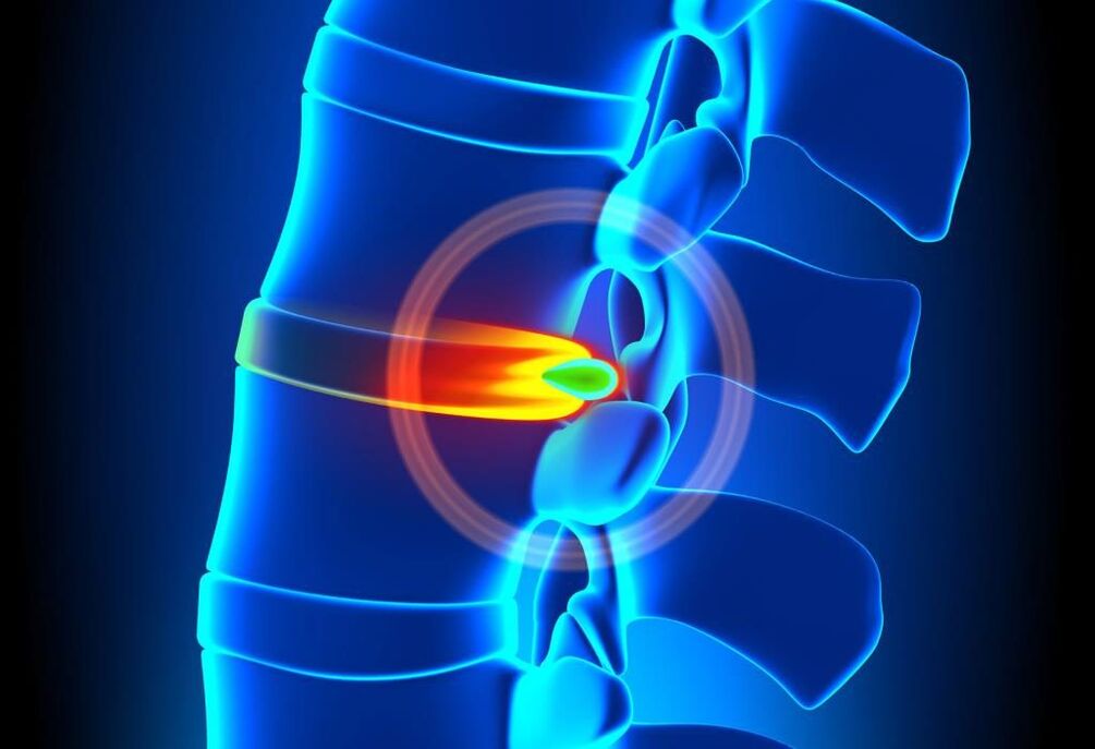 lezija hrbtenice z osteohondrozo materničnega vratu