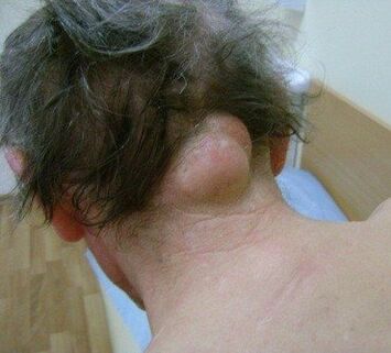 neoplazma kot vzrok za bolečine v vratu