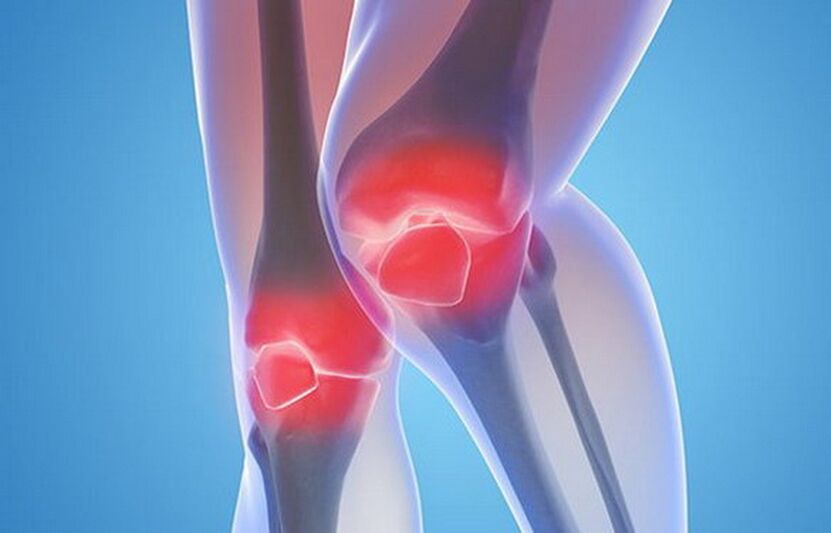 artroza kolenskih sklepov