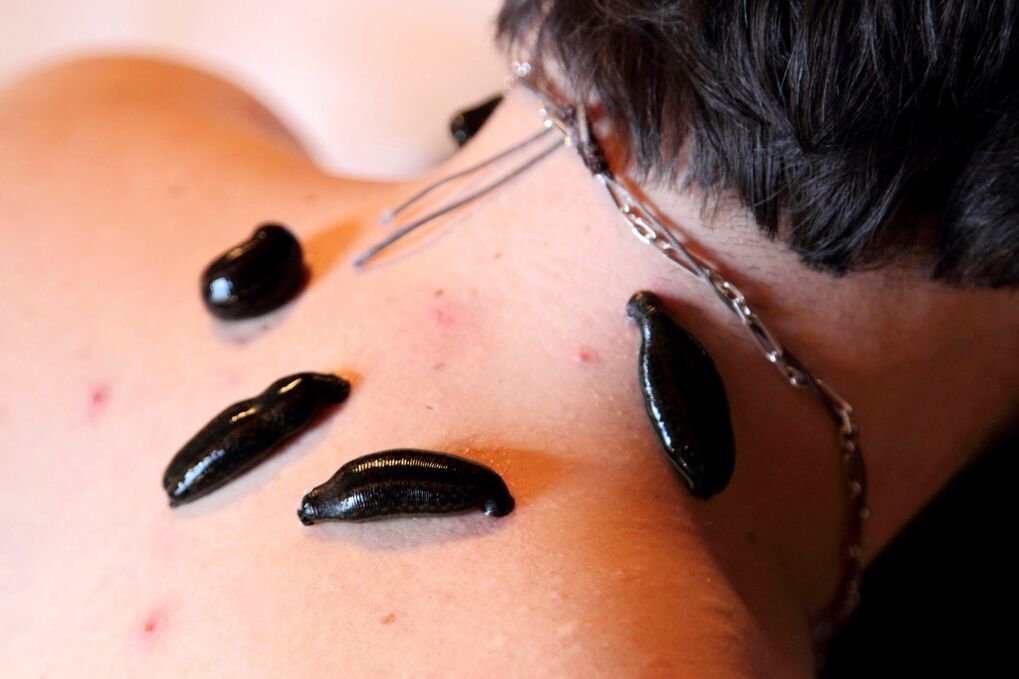 pijavke za cervikalno osteohondrozo