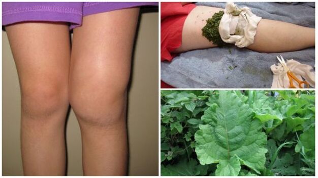 zeliščni obkladek za artrozo kolena