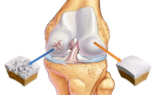 osteoartritisa kolena
